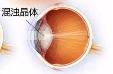原来，白内障手术没那么