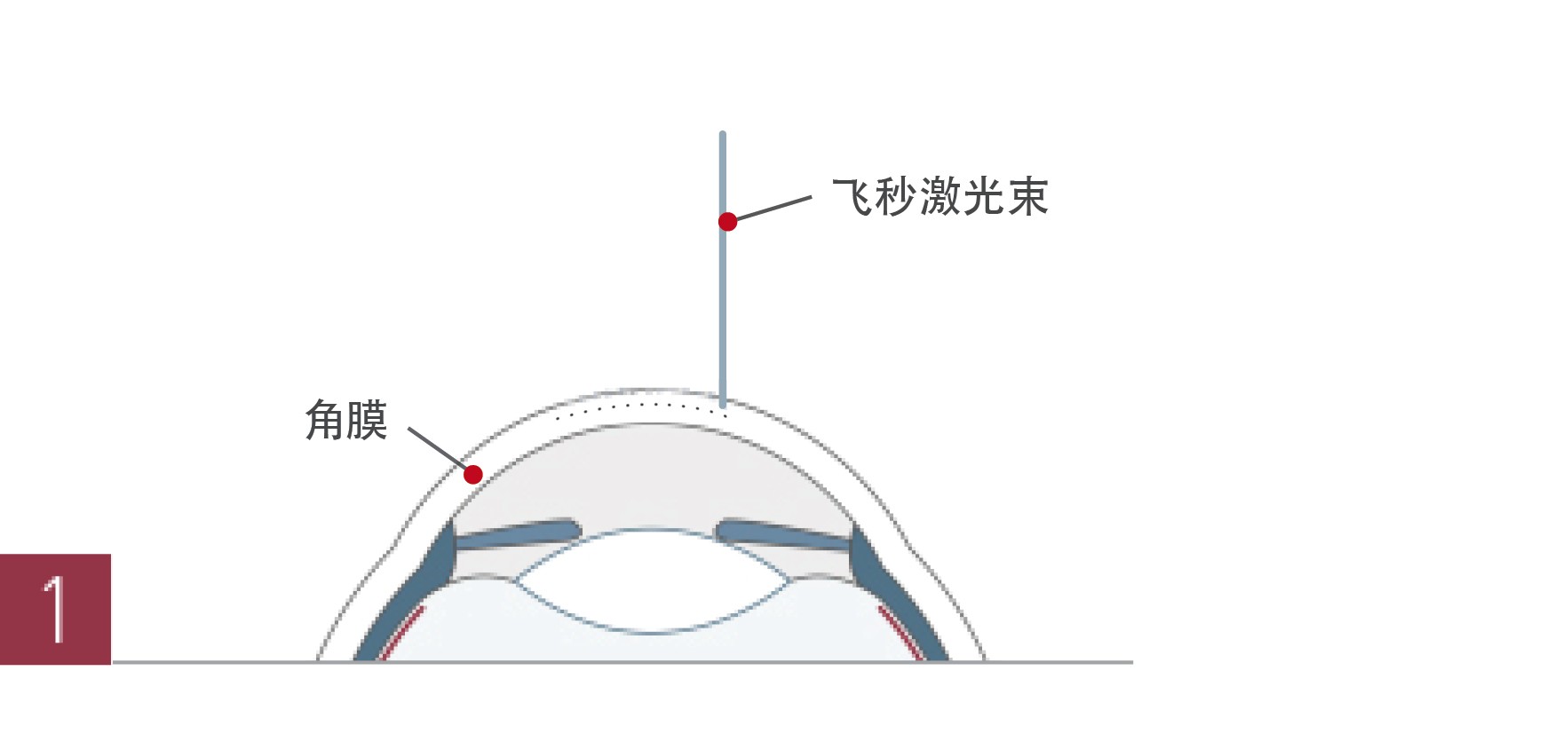 医生解析:准分子激光近视手术原理是什么