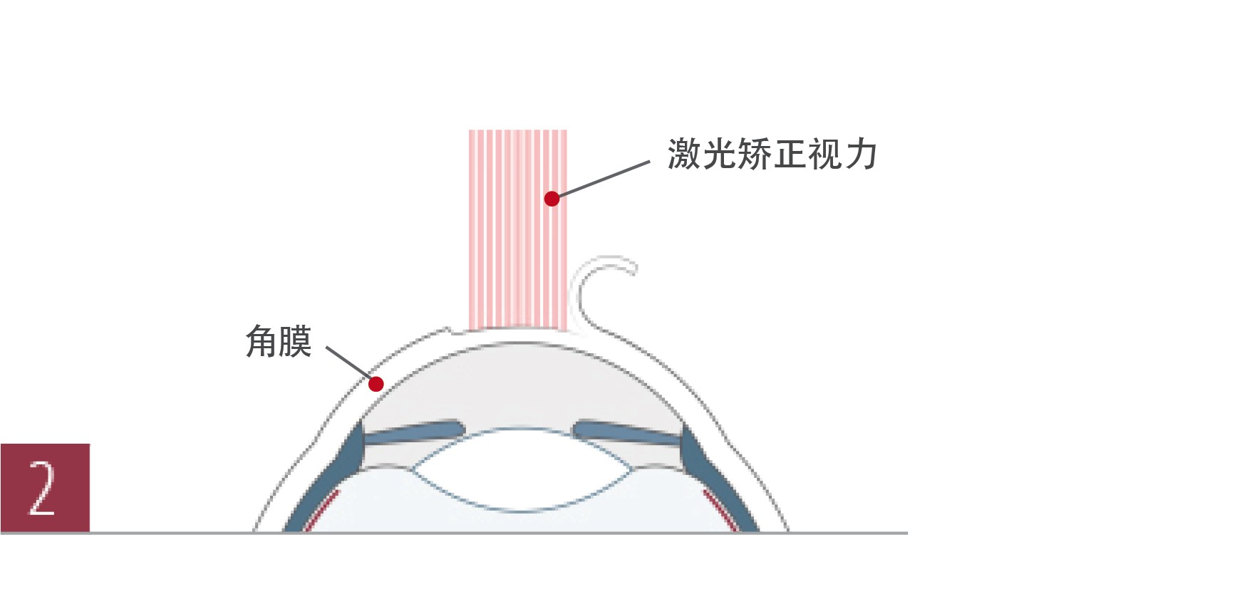 广州德视佳飞秒激光LASIK手术过程