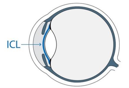 上海ICL晶体植入手术的优势