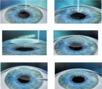 全飞秒激光近视手术是什么？