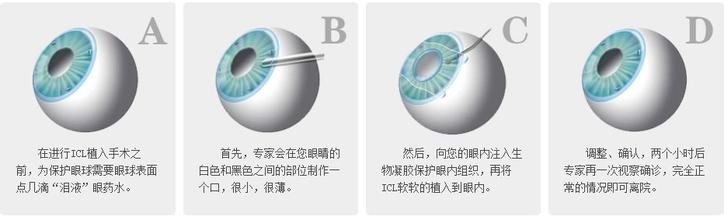 ICL晶体植入有没有副作用？