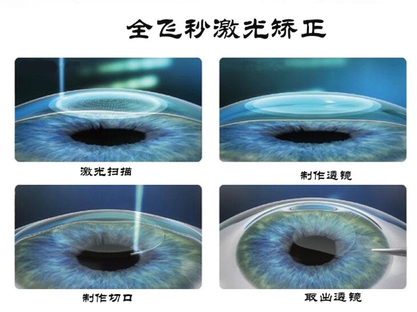 全飞秒激光矫正近视手术介绍