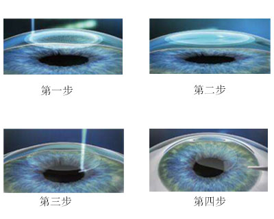 飞秒激光手术与普通近视手术的不同
