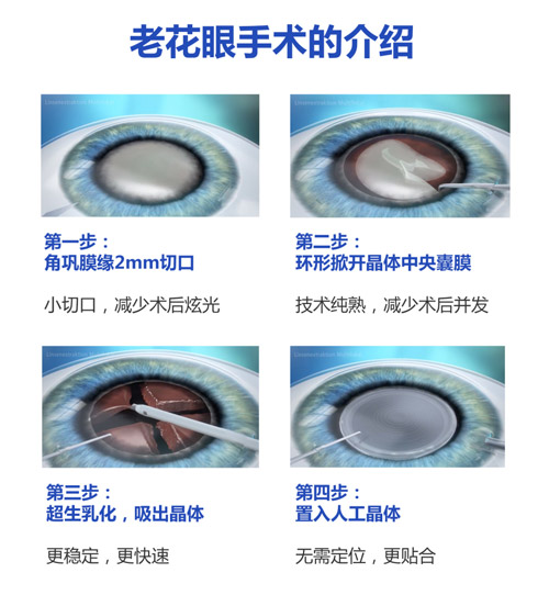 上海老花眼的手术